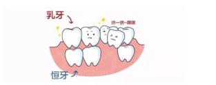 乳牙滞留1